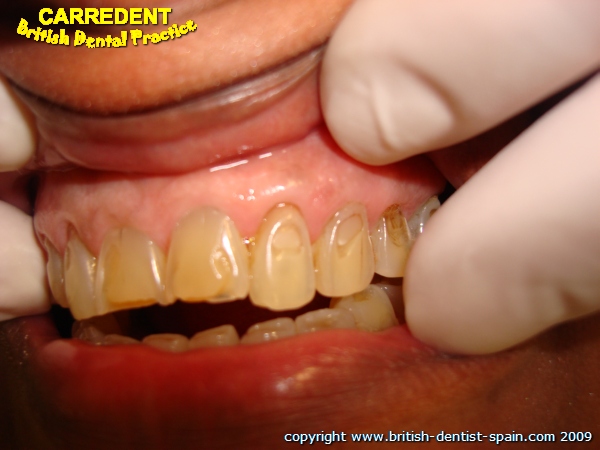 acid eroded teeth stained 1