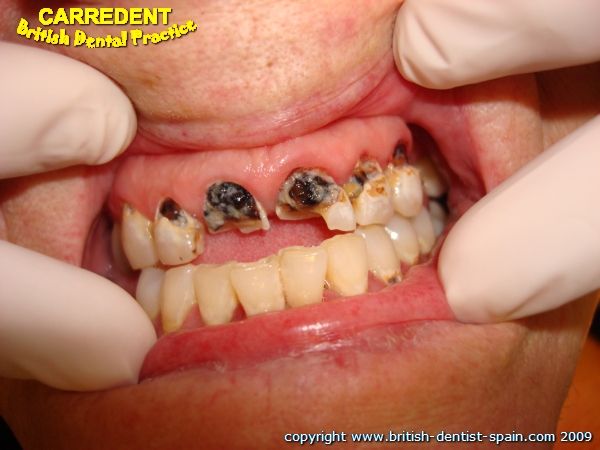 crowns fillings 1 decayed teeth