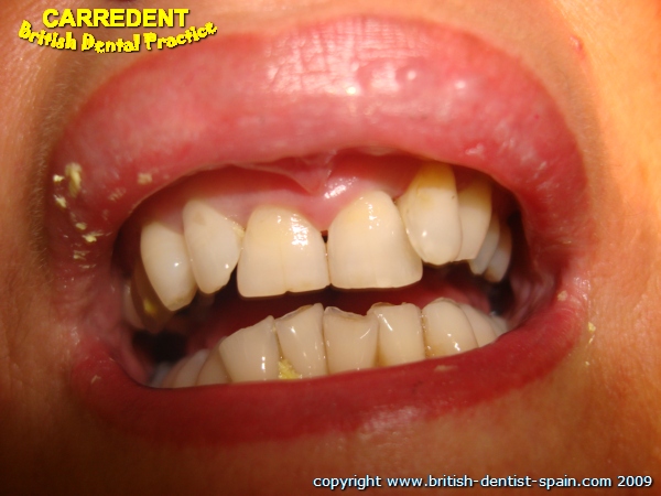 twisted teeth 1 crowns fitted