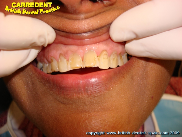 acid eroded teeth stained 2