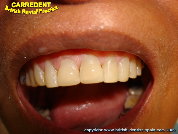 acid eroded teeth stained 3 after