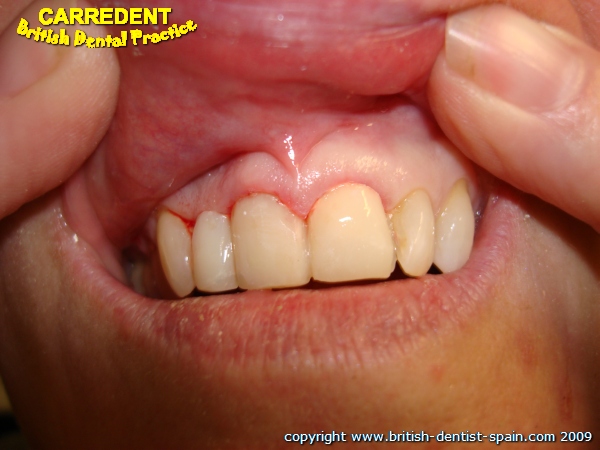 stained twisted teeth 3 immediately after treatment