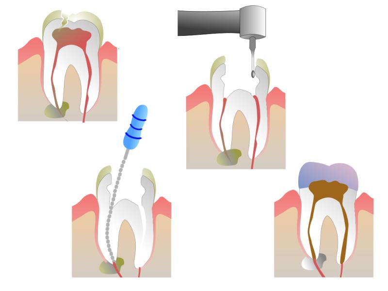 Root Canal